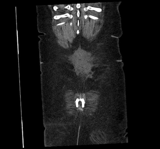 Active renal extravasation with large subcapsular and retroperitoneal hemorrhage (Radiopaedia 60975-68796 Coronal C+ portal venous phase 140).jpg