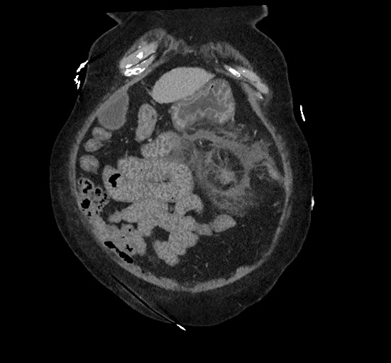 Active renal extravasation with large subcapsular and retroperitoneal hemorrhage (Radiopaedia 60975-68796 Coronal C+ portal venous phase 37).jpg