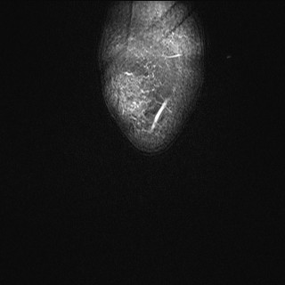 File:Acute-on-chronic transient lateral patellar dislocation with trochlear dysplasia (Radiopaedia 84099-99349 Coronal PD fat sat 39).jpg