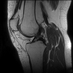 Acute-on-chronic transient lateral patellar dislocation with trochlear dysplasia (Radiopaedia 84099-99349 Sagittal PD 87).jpg