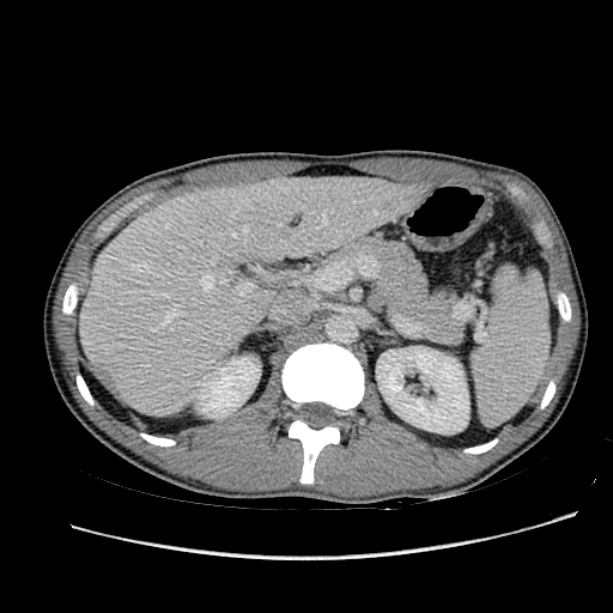 Acute appendicitis (Radiopaedia 27049-27227 Axial C+ portal venous phase 20).jpg