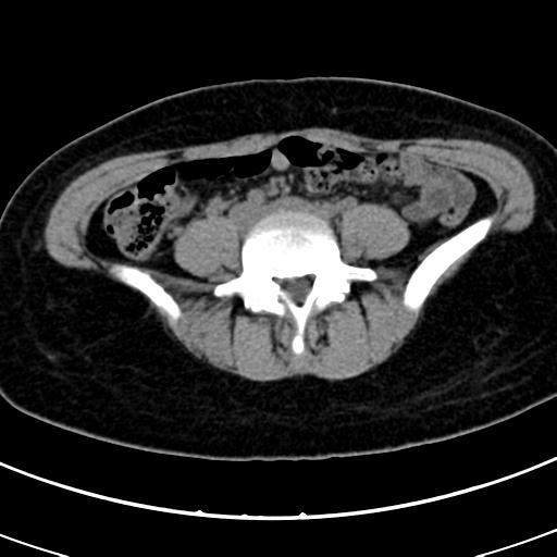 Acute appendicitis (Radiopaedia 30261-30888 Axial non-contrast 58).jpg