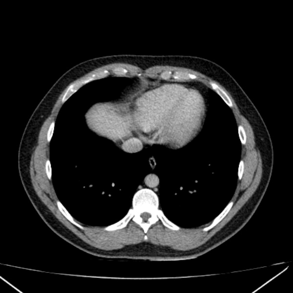 Acute appendicitis (Radiopaedia 38255-40270 Axial C+ portal venous phase 3).jpg