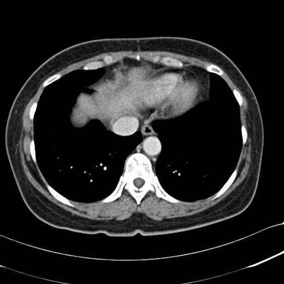 File:Acute appendicitis (Radiopaedia 48792-53822 Axial C+ portal venous phase 9).jpg