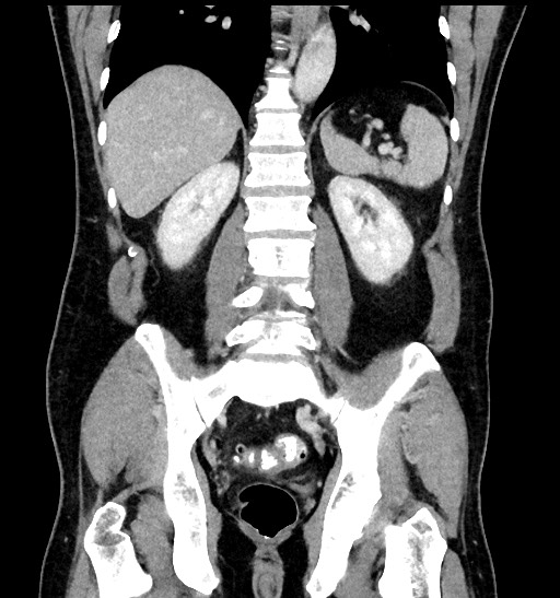 Acute appendicitis (Radiopaedia 77016-88960 Coronal C+ portal venous phase 67).jpg