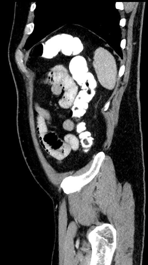 Acute appendicitis (Radiopaedia 77016-88960 Sagittal C+ portal venous phase 19).jpg