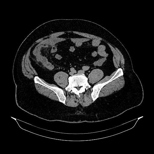 Acute appendicitis (Radiopaedia 79950-93224 Axial non-contrast 71).jpg