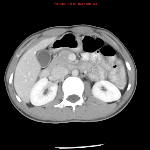 Acute appendicitis (Radiopaedia 8195-9045 Axial C+ portal venous phase 27).jpg