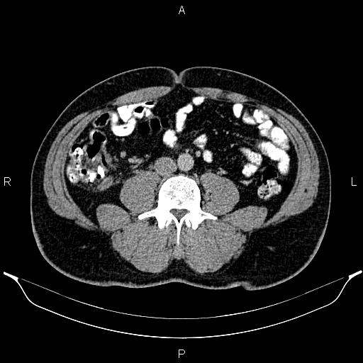 Acute appendicitis (Radiopaedia 84780-100240 Axial C+ portal venous phase 63).jpg