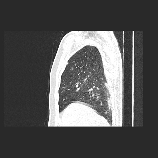 File:Acute appendicitis and COVID 19 pneumonia (Radiopaedia 76604-88380 Sagittal lung window 24).jpg