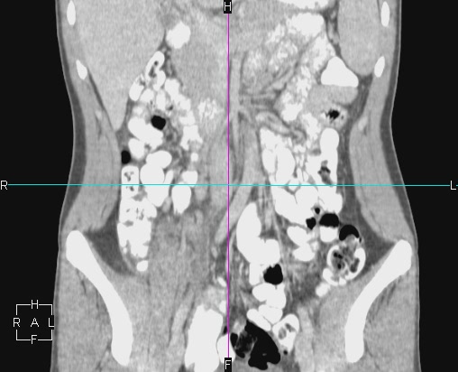 File:Acute appendicitis with CT arrowhead sign (Radiopaedia 21474-21411 Coronal C+ portal venous phase 9).JPG