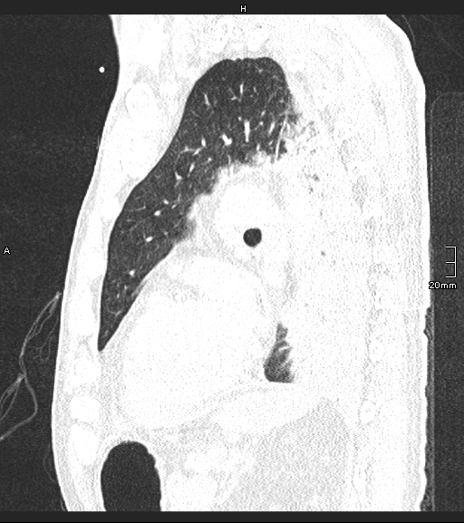 Acute aspiration pneumonitis (Radiopaedia 55642-62166 Sagittal lung window 51).jpg