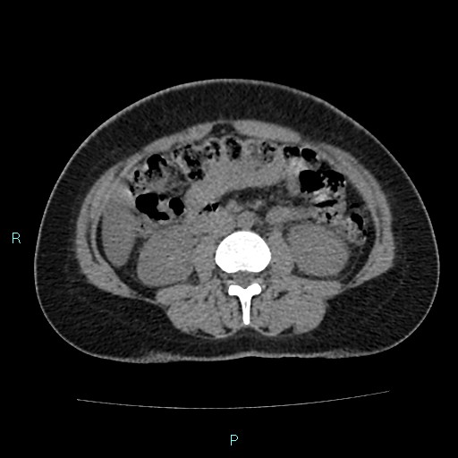 Acute bilateral pyelonephritis (Radiopaedia 37146-38881 Axial non-contrast 53).jpg