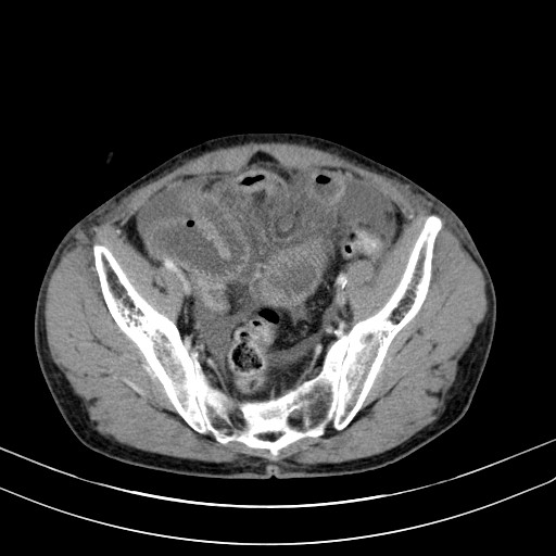 Acute bowel ischemia (Radiopaedia 87695-104114 Axial C+ portal venous phase 70).jpg