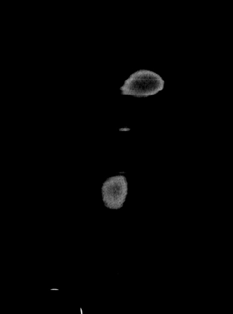 Acute bowel ischemia (Radiopaedia 87695-104114 Coronal C+ portal venous phase 47).jpg