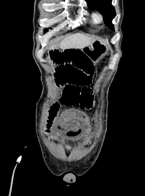 Acute bowel ischemia (Radiopaedia 87695-104114 Coronal C+ portal venous phase 91).jpg