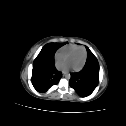 File:Acute calculous cholecystitis in patient with osteopetrosis (Radiopaedia 77871-90159 Axial non-contrast 10).jpg