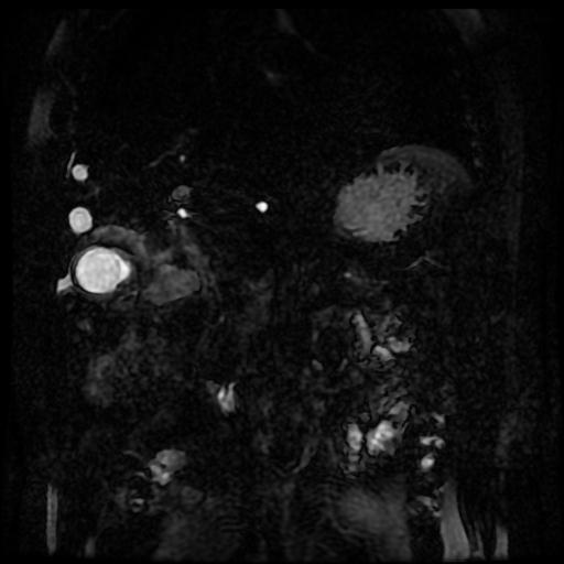 Acute cholecystitis and biliary hamartomas (Radiopaedia 86231-102240 E 81).jpg