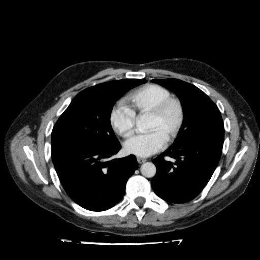 File:Acute cholecystitis and incidental left sided IVC (Radiopaedia 49352-54459 Axial C+ portal venous phase 11).jpg