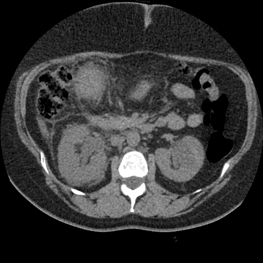 Acute cholecystitis and ureteric colic (Radiopaedia 42330-45444 Axial prone 37).jpg