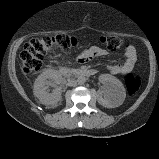 Acute cholecystitis and ureteric colic (Radiopaedia 42330-45444 Axial prone 42).jpg