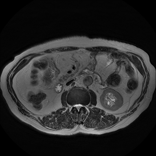 File:Acute cholecystitis complicated by pylephlebitis (Radiopaedia 65782-74915 Axial T2 28).jpg