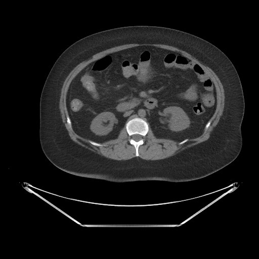 File:Acute cholecystitis with tensile fundus sign (Radiopaedia 71394-81723 Axial non-contrast 36).jpg