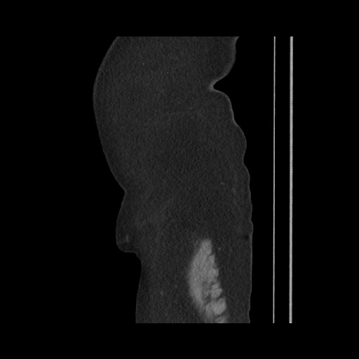 File:Acute cholecystitis with tensile fundus sign (Radiopaedia 71394-81723 Sagittal non-contrast 26).jpg