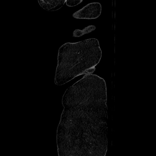Acute diverticulitis - transverse colon (Radiopaedia 87063-103327 Sagittal C+ portal venous phase 23).jpg