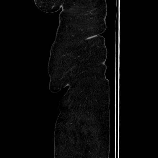 Acute diverticulitis - transverse colon (Radiopaedia 87063-103327 Sagittal C+ portal venous phase 32).jpg