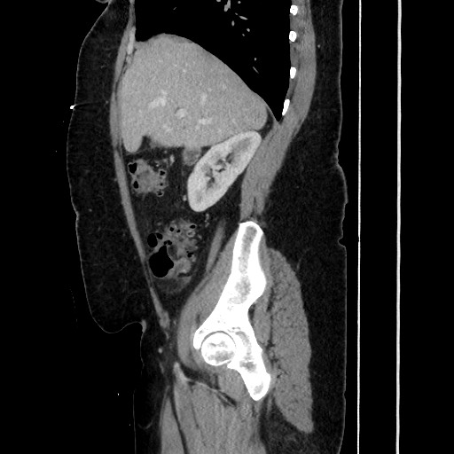 Acute diverticulitis - transverse colon (Radiopaedia 87063-103327 Sagittal C+ portal venous phase 87).jpg
