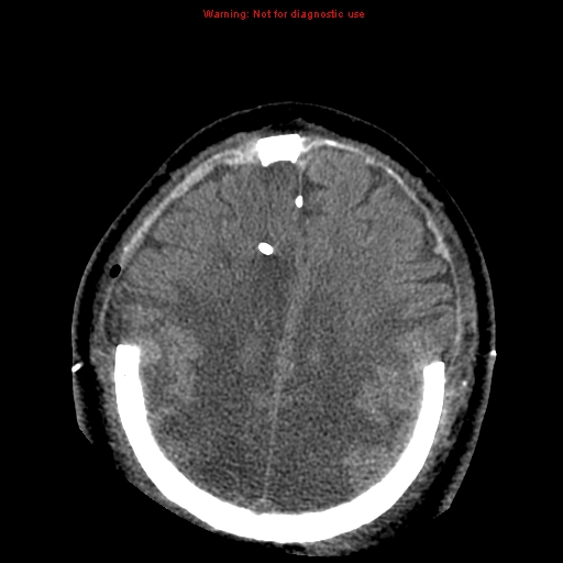 File:Acute hemorrhagic leukoencephalitis (Radiopaedia 14076-43697 Axial non-contrast 36).jpg