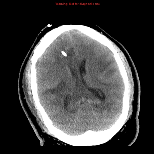 File:Acute hemorrhagic leukoencephalitis (Radiopaedia 14076-72275 Axial non-contrast 23).jpg