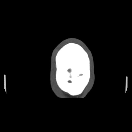 File:Acute internal carotid artery dissection (Radiopaedia 53541-59630 D 77).jpg
