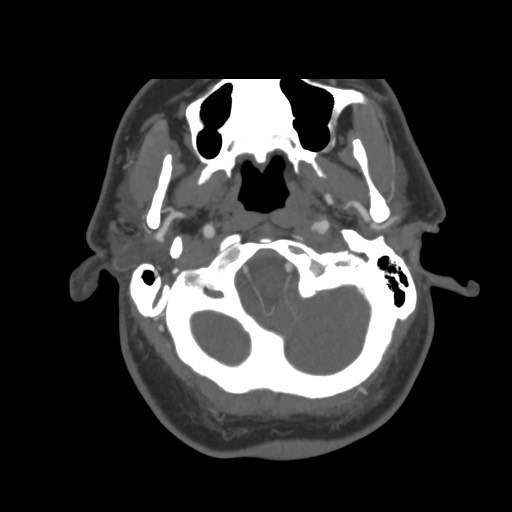 File:Acute internal carotid artery dissection (Radiopaedia 53541-59630 D 9).jpg