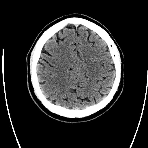 File:Acute left middle cerebral artery territory ischemic stroke (Radiopaedia 35688-37223 Axial non-contrast 61).png