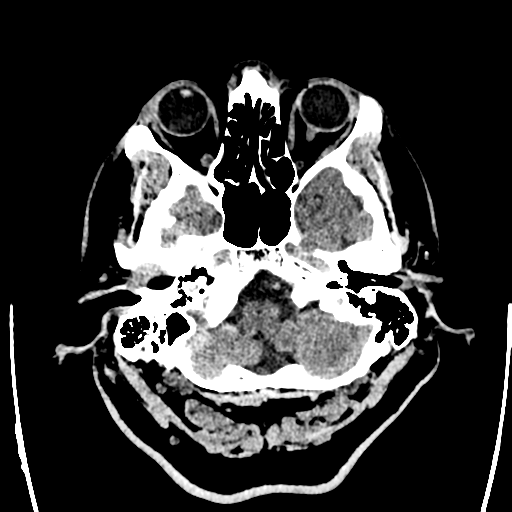 Acute left middle cerebral artery territory ischemic stroke (Radiopaedia 35688-37223 Axial non-contrast 9).png