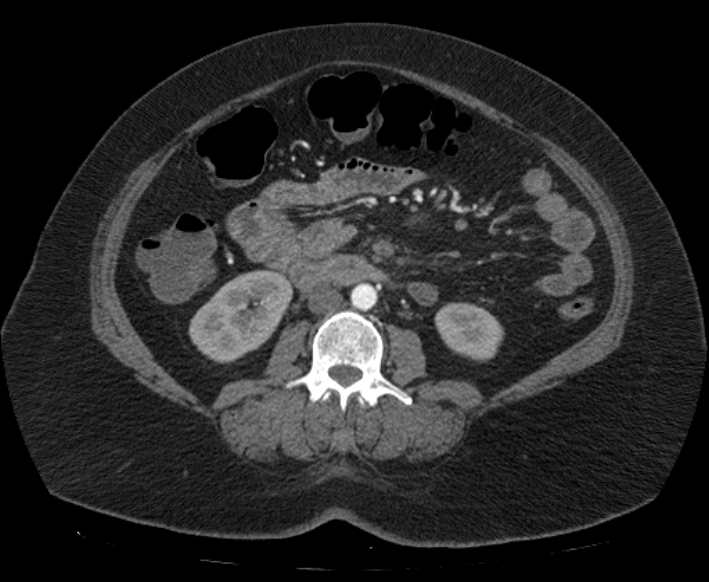 Acute mesenteric ischemia (Radiopaedia 80029-93316 Axial C+ arterial phase 63).jpg