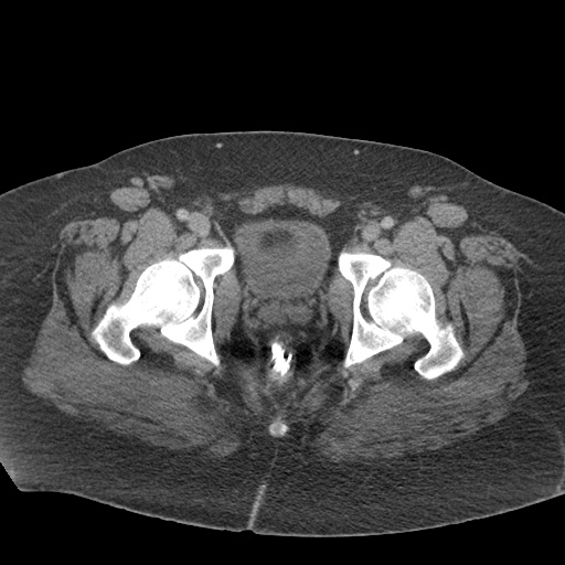 Acute mesenteric venous ischemia (Radiopaedia 46041-50383 Axial C+ portal venous phase 138).jpg