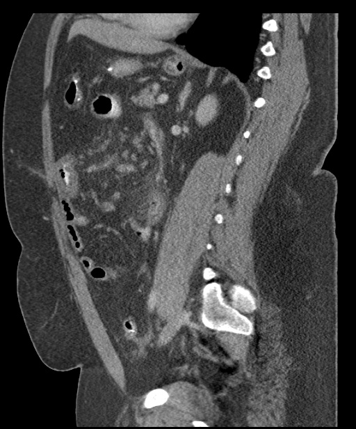 Acute mesenteric venous ischemia (Radiopaedia 46041-50383 Sagittal C+ portal venous phase 71).jpg