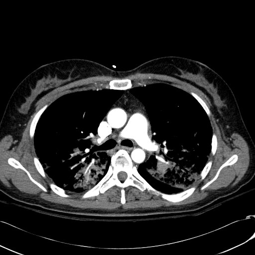 Acute myocardial infarction in CT (Radiopaedia 39947-42415 Axial C+ arterial phase 52).jpg