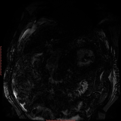 Acute necrotizing pancreatitis (Radiopaedia 28194-28448 Coronal MRCP 72).jpg