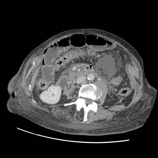 Acute on chronic pancreatitis (Radiopaedia 13233-13244 Axial C+ portal venous phase 58).jpg