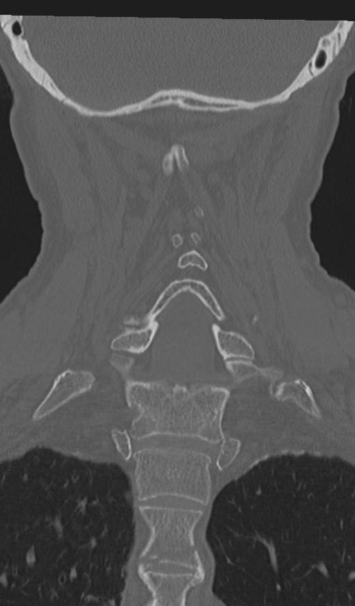 Acute on chronic subdural hematoma and thoracic vertebral injury in a multitrauma patient (Radiopaedia 31698-32619 Coronal bone window 42).jpg