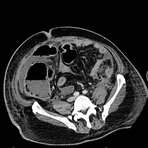 Acute pancreatic necrosis (Radiopaedia 13560-18501 Axial C+ portal venous phase 100).jpg