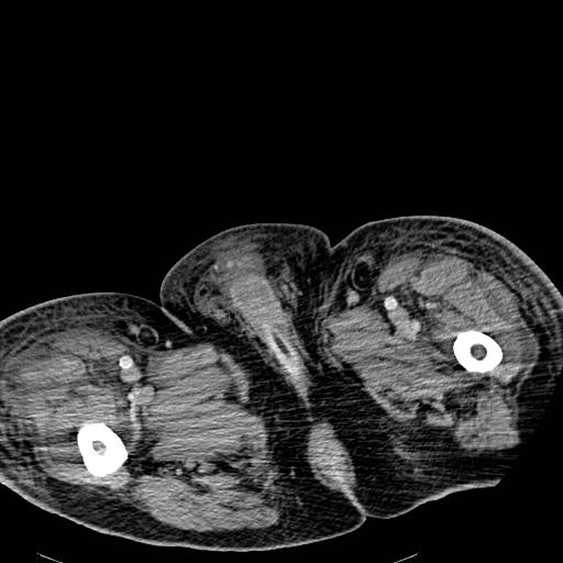 Acute pancreatic necrosis (Radiopaedia 13560-18501 Axial C+ portal venous phase 166).jpg