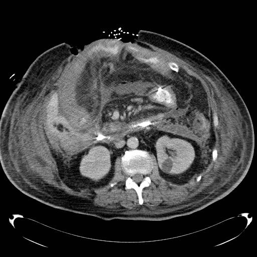 File:Acute pancreatic necrosis (Radiopaedia 13560-18503 Axial C+ portal venous phase 38).jpg