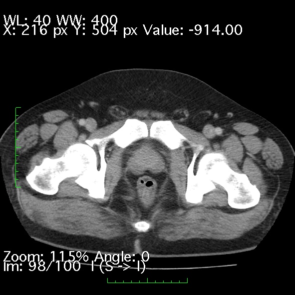 Acute pancreatitis (Radiopaedia 34043-35276 Axial C+ portal venous phase 98).jpg