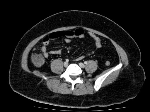 Acute pancreatitis (Radiopaedia 69236-79012 Axial C+ portal venous phase 63).jpg