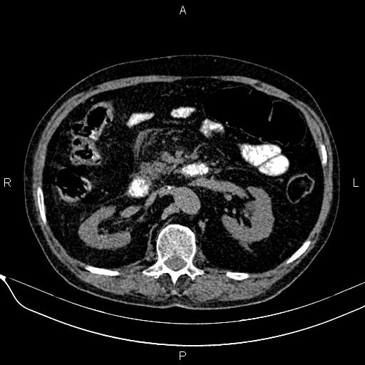 Acute pancreatitis (Radiopaedia 85146-100701 Axial non-contrast 53).jpg